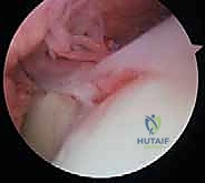 صورة توضيحية لـ تحرير تيبس المرفق بالمنظار: استعادة الحركة والحياة الطبيعية مع الأستاذ الدكتور محمد هطيف