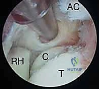 برد النتوءات العظمية بالمنظار