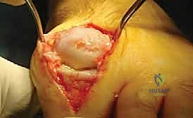 صورة توضيحية لآلام مفصل إبهام القدم الكبير