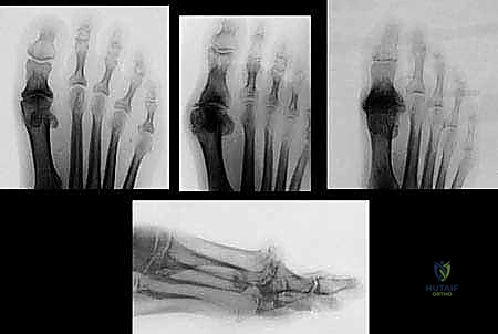 الأربطة والعظام السمسمية للإبهام