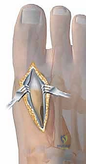 تأثير التشوهات الهيكلية على القدم