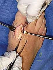 صورة طبية: تيبس إبهام القدم: حلول متقدمة لآلام المفصل وتقنية Arthrosurface HemiCAP مع الأستاذ الدكتور محمد هطيف