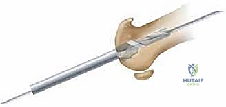 صورة طبية: تيبس إبهام القدم: حلول متقدمة لآلام المفصل وتقنية Arthrosurface HemiCAP مع الأستاذ الدكتور محمد هطيف