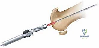 صورة طبية: تيبس إبهام القدم: حلول متقدمة لآلام المفصل وتقنية Arthrosurface HemiCAP مع الأستاذ الدكتور محمد هطيف