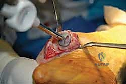 صورة طبية: تيبس إبهام القدم: حلول متقدمة لآلام المفصل وتقنية Arthrosurface HemiCAP مع الأستاذ الدكتور محمد هطيف