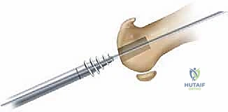 صورة طبية: تيبس إبهام القدم: حلول متقدمة لآلام المفصل وتقنية Arthrosurface HemiCAP مع الأستاذ الدكتور محمد هطيف