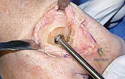 صورة طبية: تيبس إبهام القدم: حلول متقدمة لآلام المفصل وتقنية Arthrosurface HemiCAP مع الأستاذ الدكتور محمد هطيف