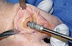 صورة طبية: تيبس إبهام القدم: حلول متقدمة لآلام المفصل وتقنية Arthrosurface HemiCAP مع الأستاذ الدكتور محمد هطيف