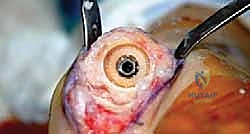 صورة توضيحية لـ تيبس إبهام القدم: حلول متقدمة لآلام المفصل وتقنية Arthrosurface HemiCAP مع الأستاذ الدكتور محمد هطيف