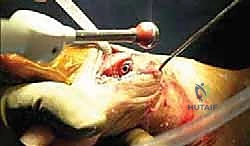 استخدام النعال الطبية والأحذية الخاصة