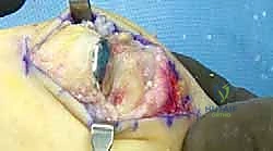 جراحة استئصال النتوءات العظمية