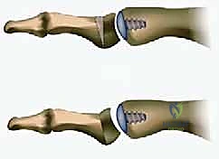 جراحة دمج المفصل
