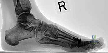 صورة طبية: تيبس إبهام القدم: حلول متقدمة لآلام المفصل وتقنية Arthrosurface HemiCAP مع الأستاذ الدكتور محمد هطيف