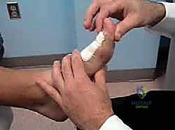 الأشعة السينية لمراحل تيبس الإبهام