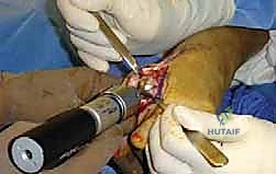 صورة طبية: تيبس إبهام القدم: حلول متقدمة لآلام المفصل وتقنية Arthrosurface HemiCAP مع الأستاذ الدكتور محمد هطيف