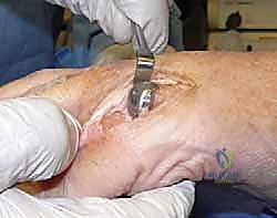 Illustration of articular cartilage loss - Dr. Mohammed Hutaif