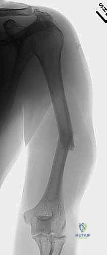 صورة توضيحية لـ علاج كسر عظم العضد بالمسمار النخاعي الأمامي: دليل شامل للمرضى مع الأستاذ الدكتور محمد هطيف