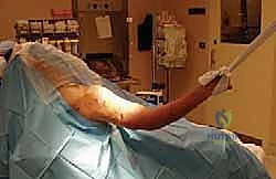 صورة توضيحية لـ علاج كسر عظم العضد بالمسمار النخاعي الأمامي: دليل شامل للمرضى مع الأستاذ الدكتور محمد هطيف