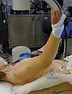 صورة توضيحية لـ علاج كسر عظم العضد بالمسمار النخاعي الأمامي: دليل شامل للمرضى مع الأستاذ الدكتور محمد هطيف