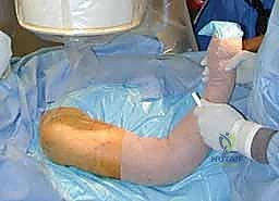 صورة توضيحية لـ علاج كسر عظم العضد بالمسمار النخاعي الأمامي: دليل شامل للمرضى مع الأستاذ الدكتور محمد هطيف