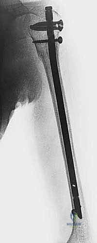 صورة توضيحية لـ علاج كسر عظم العضد بالمسمار النخاعي الأمامي: دليل شامل للمرضى مع الأستاذ الدكتور محمد هطيف