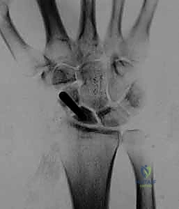 الخيارات الجراحية المتقدمة للرسغ