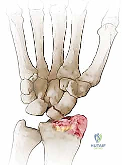 مدى الحركة بعد الجراحة