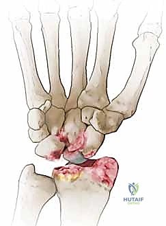 استئصال القطب البعيد للعظم الزورقي لعلاج متلازمة SNAC الرسغ: دليل شامل للمرضى مع الأستاذ الدكتور محمد هطيف