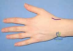 تشريح مفصل الرسغ والعظم الزورقي