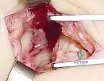 إغلاق الجرح الجراحي