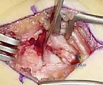 خطوات استئصال القطب البعيد