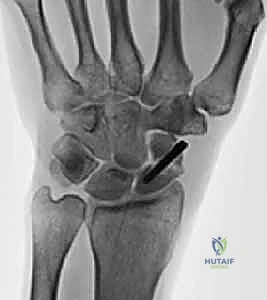 التروية الدموية للعظم الزورقي