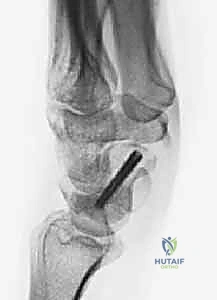 التشخيص الإشعاعي لمتلازمة SNAC