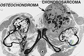 الأعراض السريرية لأورام الحوض