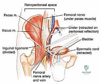 Illustration of posterior flap hemipelvectomy - Dr. Mohammed Hutaif