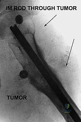 تصميم السديلة الخلفية Posterior Flap