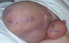 أخذ الخزعة الطبية