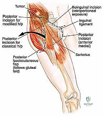 مقارنة الخيارات الجراحية