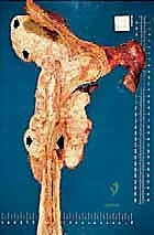 صورة توضيحية لـ عملية بتر النصف الحوضي الخلفي: دليل شامل للمرضى مع الأستاذ الدكتور محمد هطيف في صنعاء