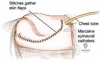 ربط الأوعية الدموية الرئيسية