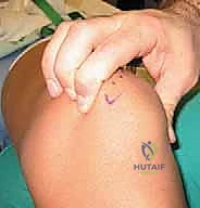 Proximal Patellar Realignment: Medial Patellofemoral Ligament Reconstruction & Retinacular Plication Masterclass