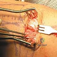 خطوات جراحة إعادة توجيه الرضفة بالمنظار