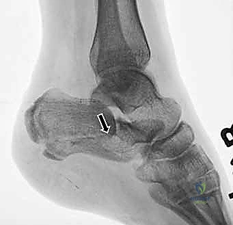 آلية حدوث كسر الكعب