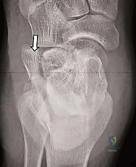 صورة الأشعة المقطعية لكسر الكعب