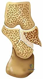 النهج الجانبي الموسع