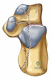 تثبيت السديلة الجلدية