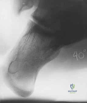 النتيجة النهائية بالأشعة