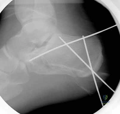 تثبيت المسامير