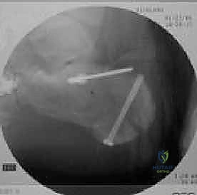 رفع السديلة الجلدية