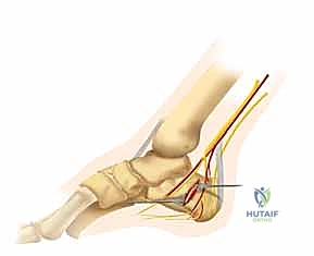شريحة التيتانيوم النهائية